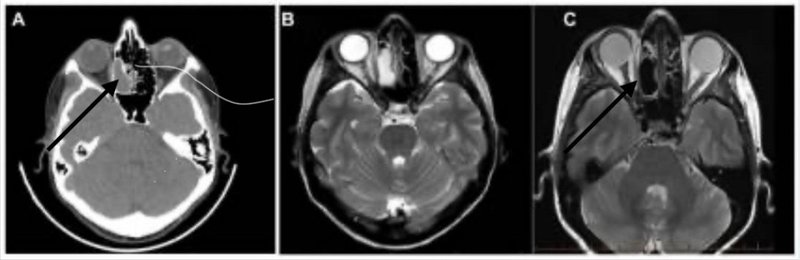 MRI toont gezond neusslijmvlies na regelmatig drinken van Biotona Imperial Gyokuro.