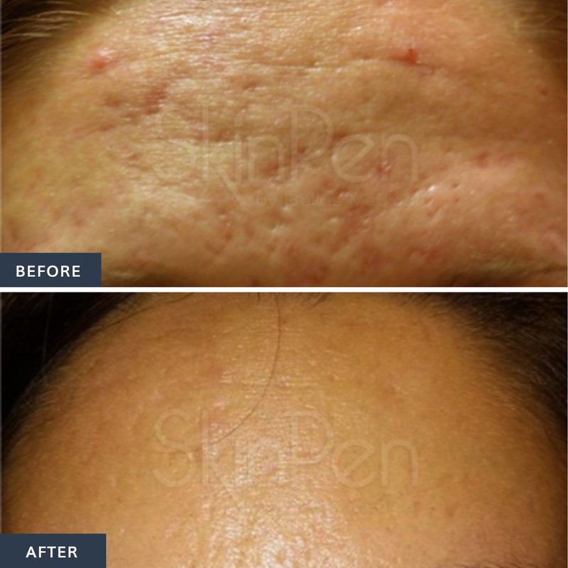 acne littekens behandelen