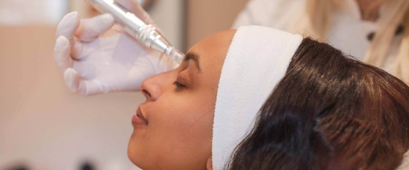microneedling amsterdam