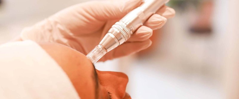 Skinpen microneedling