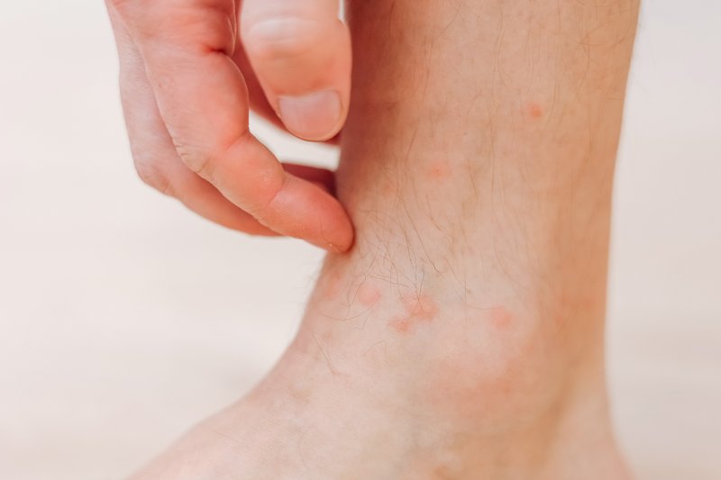 Close up man scratching with hand allergic rash on leg. Leg with red rash caused by insect bites. Dermatitis, folliculitis, fungal infection. Affected area of red and blotchy and to swell skin.