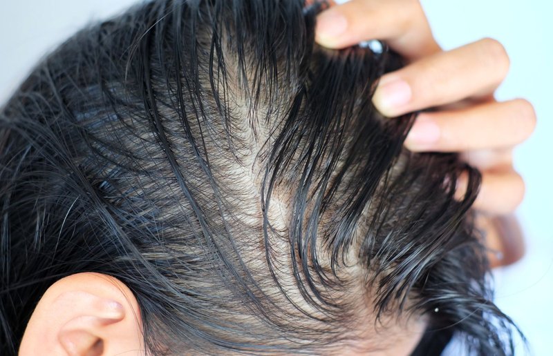 oily scalp