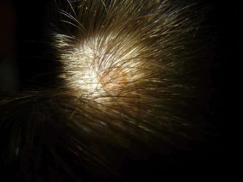 Red spots on scalp, a sign of imbalance or irritation on an otherwise healthy scalp.