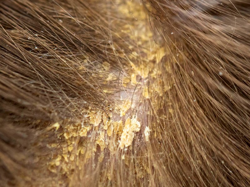 Can adults get cradle cap?