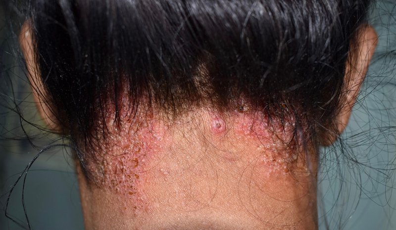 Why Do I Have Crusty Scabs on My Scalp? 