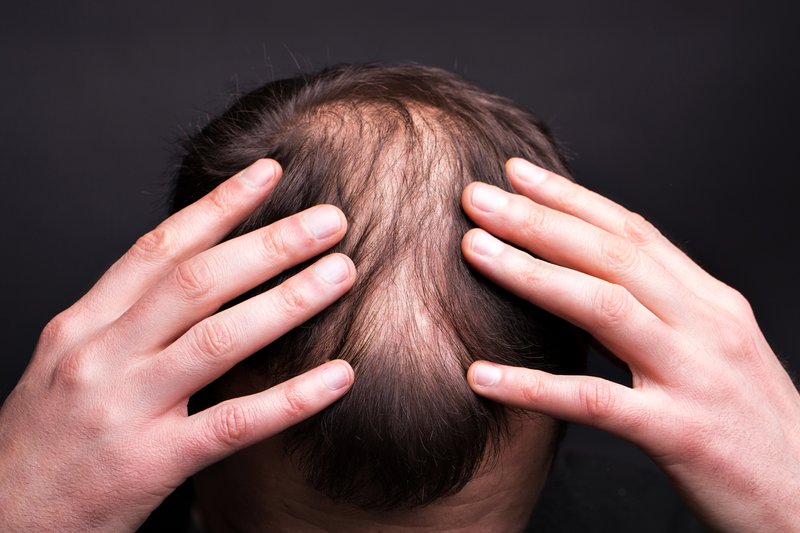 Red light therapy for hair loss before and after