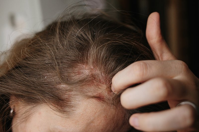 eczema on scalp