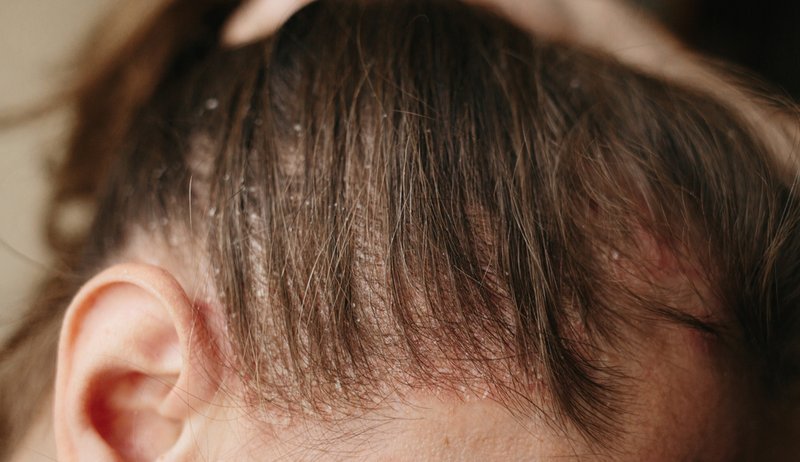 scalp psoriasis vs dandruff