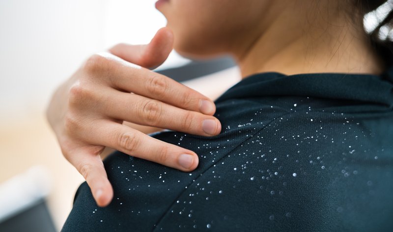 scalp psoriasis vs dandruff