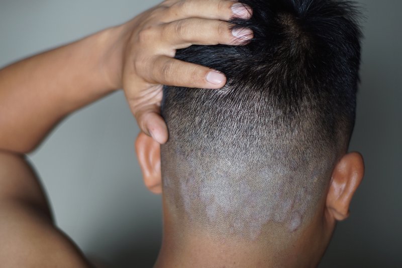scalp psoriasis