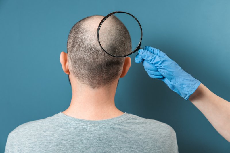 what causes hair loss