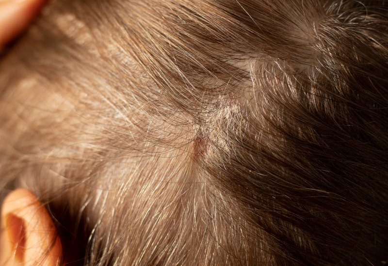Why Do I Have Crusty Scabs on My Scalp? 