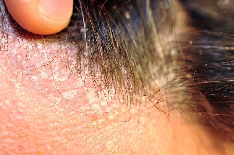 scalp eczema treatment