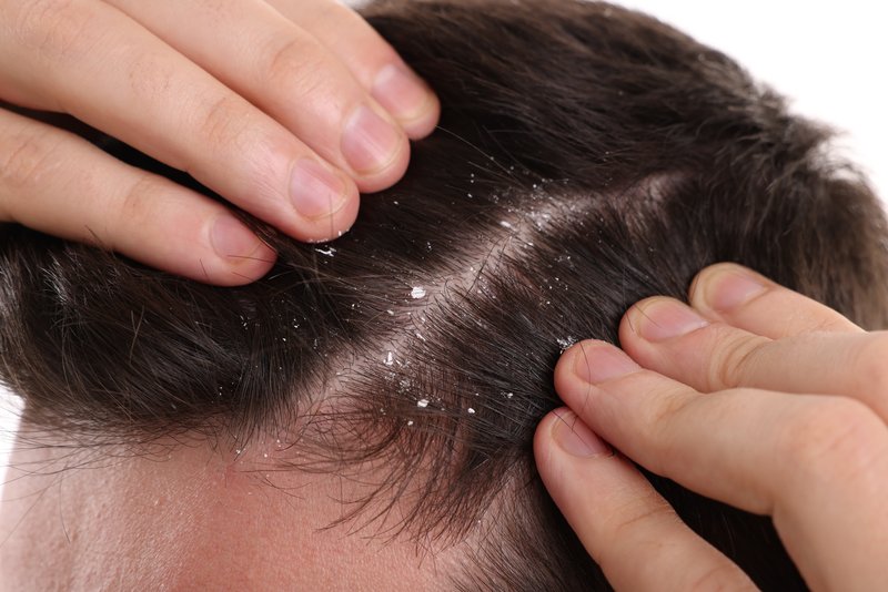 dandruff vs dry scalp that could lead to hair loss