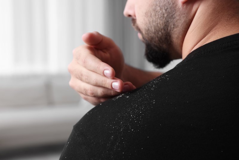 dandruff vs dry scalp that could lead to hair loss
