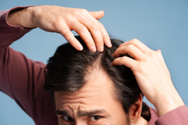 Does Mounjaro Cause Hair Loss?