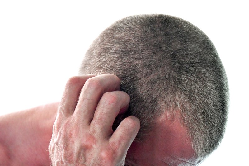Adult cradle cap forming.