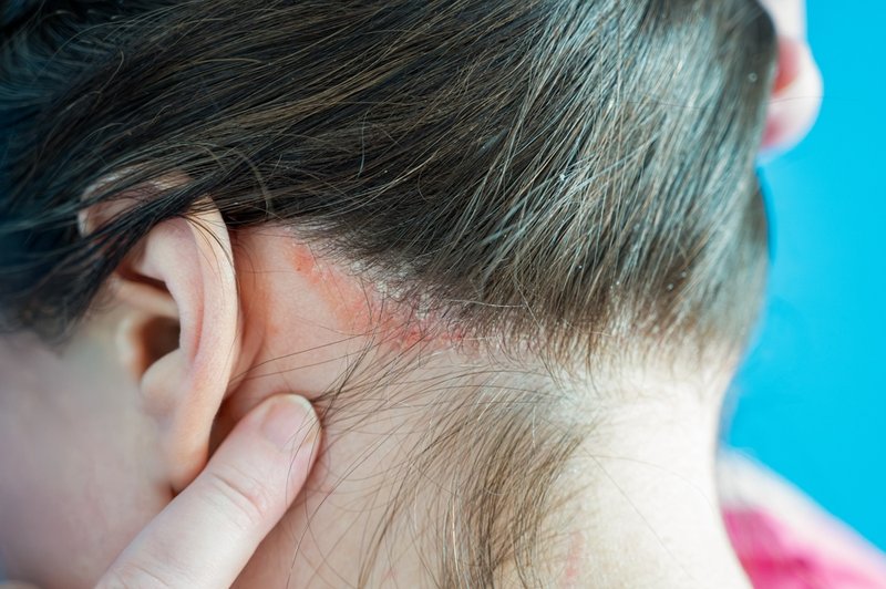 psoriasis vs eczema