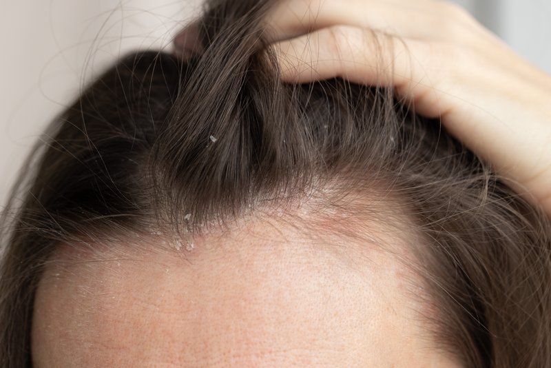 does dandruff cause hair loss