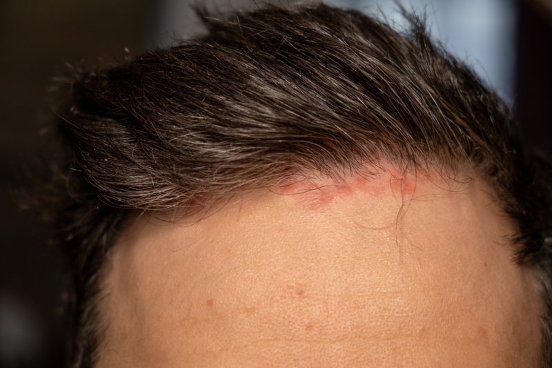 A man with red patches on scalp.