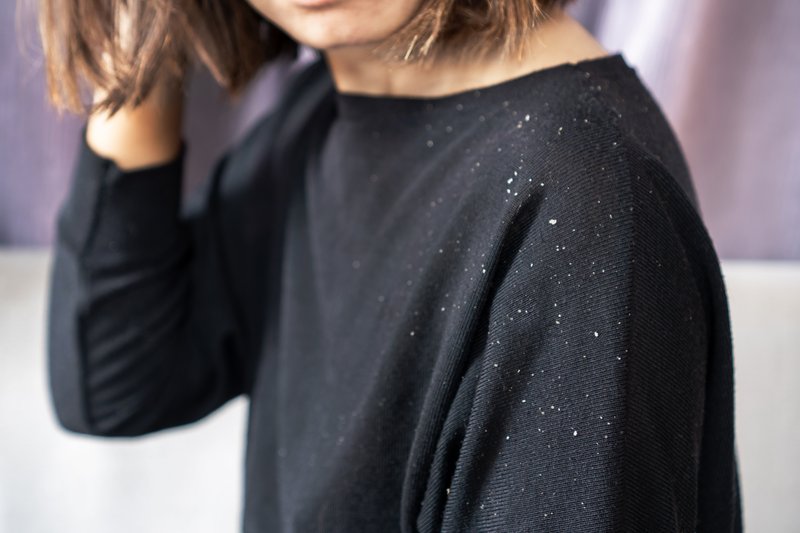 does dandruff cause hair loss