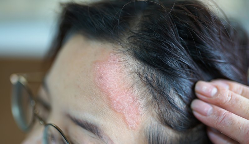 A woman with red patches on scalp.