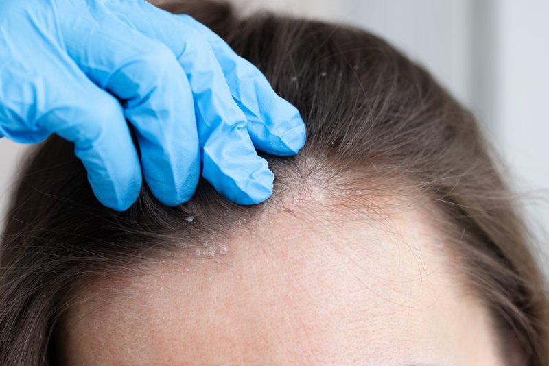Adult cradle cap on a woman.