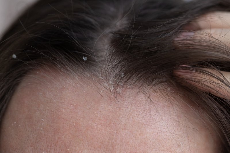 scalp psoriasis vs dandruff