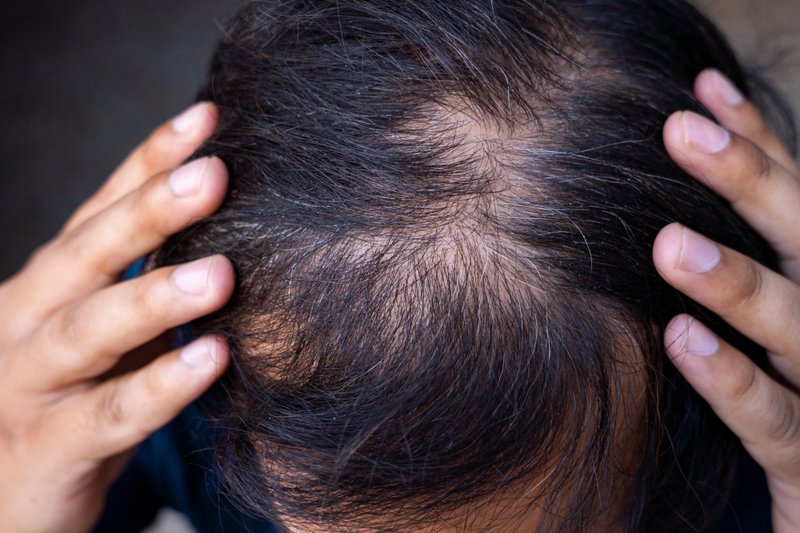 Scalp peeling off in chunks.