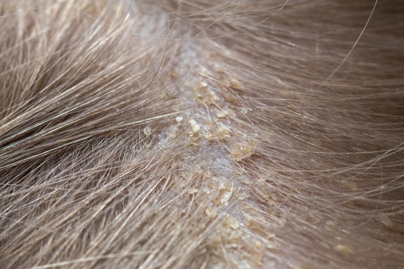 Can adults get cradle cap.