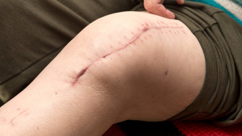 Scar tissue from a recent knee replacement surgery.