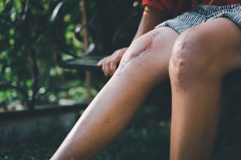 Patient knees after knee replacement surgery