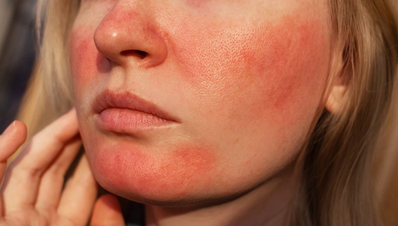 Sensitive Skin