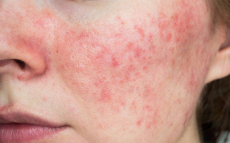An irritated skin due to over exfoliation