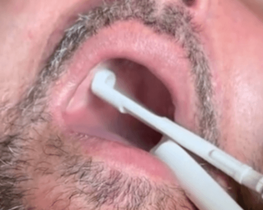 applying dental topical anesthetic for your workflow