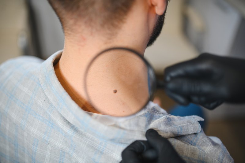 Health screenings, doctor checking a skin tag